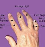 Image result for Wart Forming On Finger