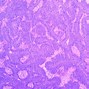 Image result for Cutaneous Papilloma