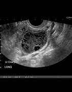 Image result for 25 Cm Ovarian Cyst