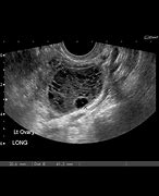 Image result for Cyst On Uterus 5Cm