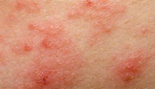 Image result for Skin Cancer Symptoms Itchy Rash