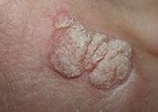 Image result for Molluscum in the Armpit
