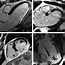 Image result for MRI Imaging Myocardial Infarction