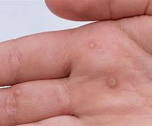Image result for Contagious Bumps On Skin