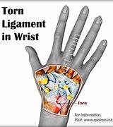 Image result for Wrist Ligament Tear