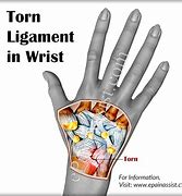 Image result for Torn Ligament in Wrist