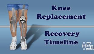 Image result for Knee Replacement Surgery Recovery