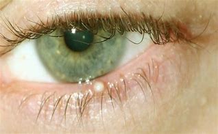 Image result for White Bump On Inner Eyelid