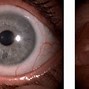 Image result for Toric Notch Contact Lens