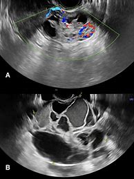 Image result for Cystadenocarcinoma Ovary Ultrasound