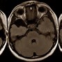 Image result for Arachnoid Cyst