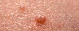 Image result for Molluscum Treatment Before and After
