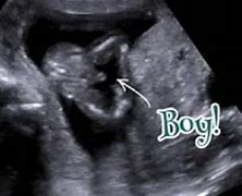 Image result for 15 Weeks Pregnant Ultrasound