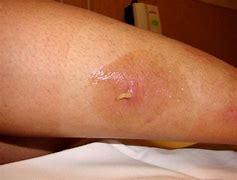 Image result for Bot Fly Larvae in Skin
