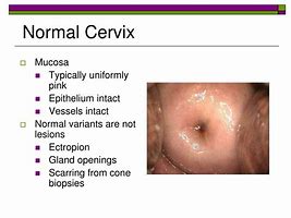 Image result for Normal Cervical Ectropion