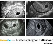 Image result for Early Pregnancy Ultrasound 5 Weeks