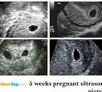 Image result for 5 Weeks 2 Days Pregnant