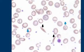 Image result for Sickle Cell Anemia Blood Smear