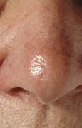 Image result for Basal Cell Carcinoma