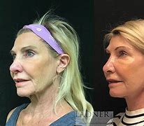 Image result for Facelift and Neck Lift Surgery