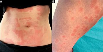 Image result for Autoimmune Skin Eruptions