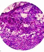 Image result for What Is a Lung Nodule