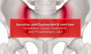 Image result for Sacroiliac Joint Dysfunction Treatment