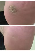 Image result for Surgical Removal of Warts