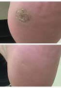 Image result for Warts Laser Treatment