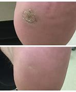 Image result for Wart Surgical Removal