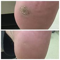 Image result for Flat Wart Removal Treatme.net