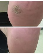 Image result for Wart After Removal