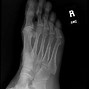 Image result for Acute Jones Fracture