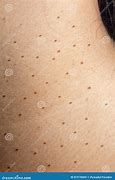 Image result for Senior Warts