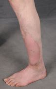Image result for Soft Tissue Sarcoma Leg
