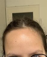 Image result for Lumpy Forehead