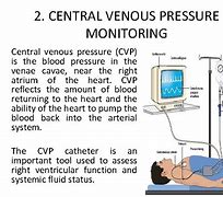 Image result for Central Venous Pressure Hemodynamic Monitoring