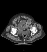 Image result for Closed Loop Obstruction Radiology