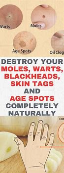 Image result for How to Get Rid of Old Age Warts