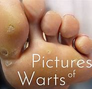 Image result for A Wart