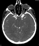 Image result for CT Image of Head and Neck in PC Screen