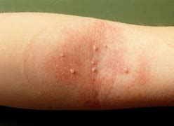 Image result for Molluscum Contagiosum Elbow