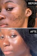 Image result for Salicylic Acid On Black Skin