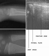 Image result for Torus Fracture