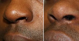 Image result for Nose Wart Removal