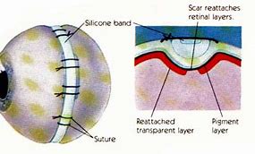 Image result for Eye Retina and Band Surgery