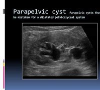 Image result for Parapelvic vs Peripelvic Cyst