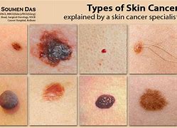 Image result for Lump On Skin Cancer