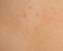 Image result for Molluscum Contagiosum On Dark Skin