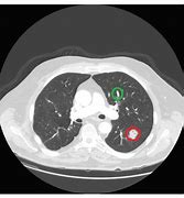 Image result for Lung Nodules Lower Lobe CT Scan